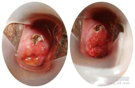 宫颈息肉的治疗方法 宫颈息肉中药治疗 宫颈息肉的中药治疗方法