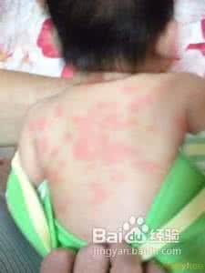 小孩青霉素过敏症状 青霉素过敏的判断