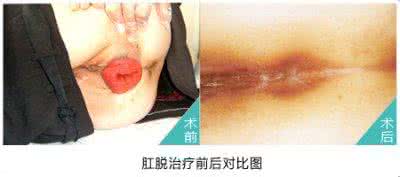 一剂治愈结石的秘方 成功治愈“脱肛”的秘方
