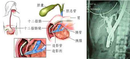 胆结石是怎么得来的 胆结石是怎么来的？