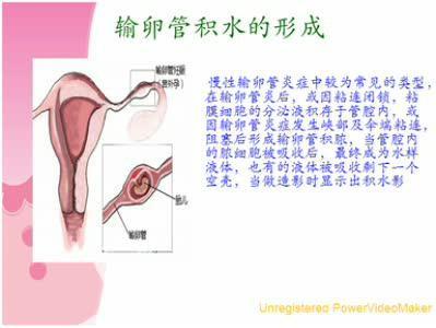 输卵管积水怎么引起的 输卵管积水的原因 引起输卵管积水的原因