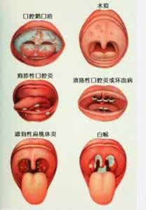 严重的口腔疾病有哪些 能从口腔发现的六种严重疾病