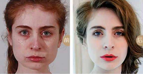 皮秒激光祛斑 激光祛斑技术 四大激光祛斑技术大PK