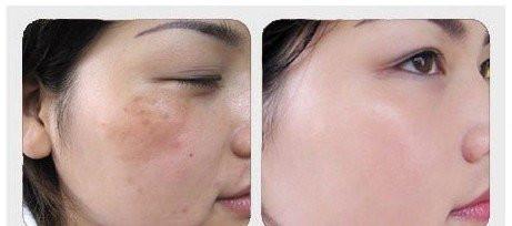 脸上长斑怎样去掉 脸上长斑怎样去掉 教你一个省钱祛斑效果又好的方法