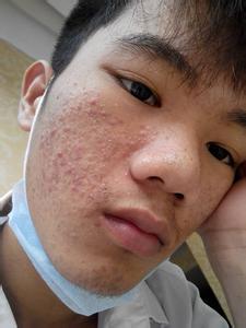 面部痤疮怎么办 面部痤疮 面部痤疮怎么办