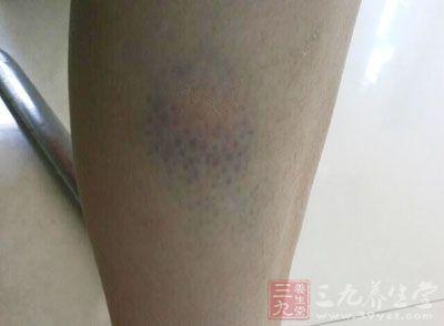 十大令人羡慕的怪病 淤血怎么办 它才是导致怪病丛生的元凶