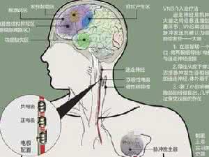 额叶综合征怎么治疗 额叶癫痫 额叶癫痫要怎样治疗