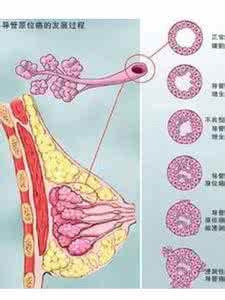 乳腺导管内癌早期症状 乳腺导管瘤早期症状主要有哪些