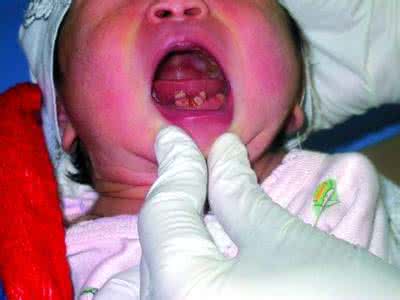 牙齿碎了一小块会长吗 牙齿碎了一小块会长吗 新生儿为什么会长牙齿？