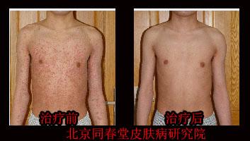 荨麻疹验方 治疗荨麻疹3个中药验方