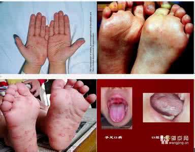 手足口病阴性 手足口阴性和阳性区别 手足口综合症