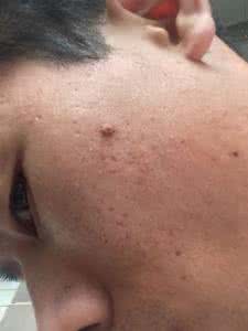 医院用的消毒水是什么 脸上痘痘用什么消毒水？