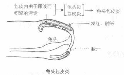 割包皮后龟头肿怎么办