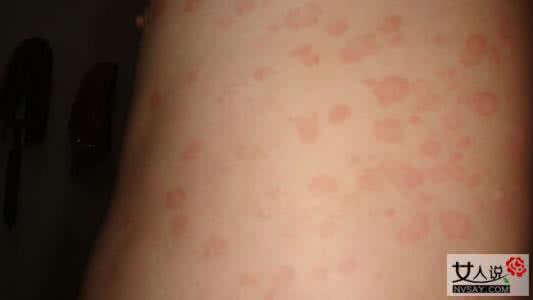 结缔组织病早期症状 结缔组织病早期症状 结缔组织病的七大病变症状