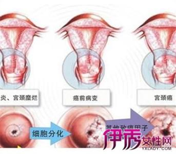 宫颈管炎 宫颈管炎上药效果好吗？