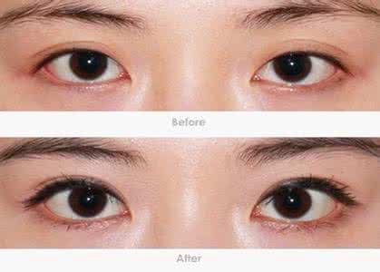 双眼皮手术多久能化妆 双眼皮手术多久能化妆 双眼皮手术后化妆小技巧