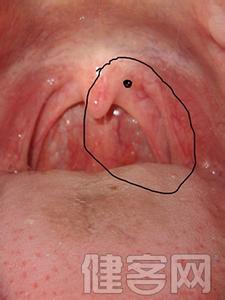 小儿慢性咽炎怎么治疗 小儿慢性咽炎怎么治疗呢