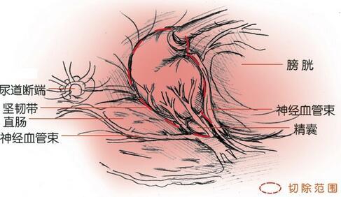 前列腺癌的早期症状 前列腺癌 前列腺癌症