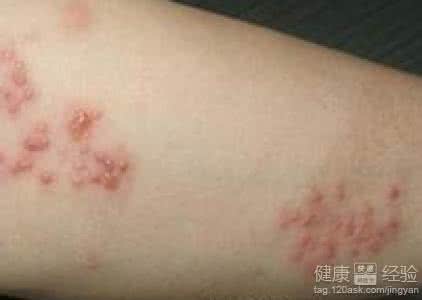 单纯疱疹igg高 单纯疱疹igg高 单纯疱疹igg