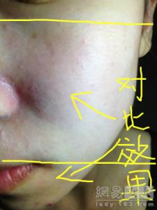 去黑头收缩毛孔小妙招 去黑头毛孔 去黑头缩毛孔