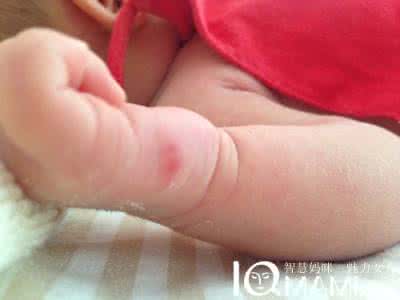 新生儿蚊子叮咬怎么办 宝宝被蚊子叮咬了怎么办