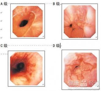 反流性食管炎症状治疗 反流性食管炎症状 反流性食管炎怎么治疗