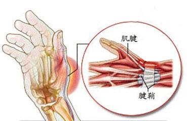 腱鞘炎最佳治疗偏方 治腱鞘炎的方子