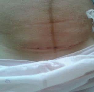 剖腹产视频全部过程 剖腹产视频全部过程 剖腹产全过程是什么