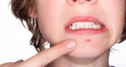 下巴长痘痘怎么调理 下巴长痘痘是什么原因 教你下巴长痘痘怎么调理