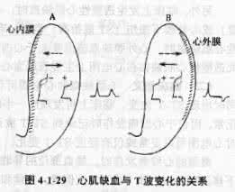 心肌缺血心电图改变 心肌缺血与ST-T改变