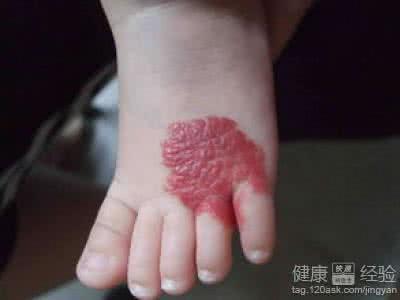 肝脏血管瘤有什么症状 肝脏血管瘤症状 肝脏血管瘤症状 肝脏血管瘤有哪些临床表现