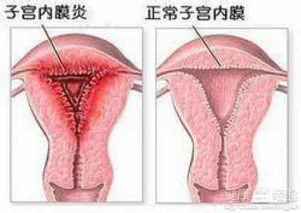 结核性子宫内膜炎 结核性子宫内膜炎 结核性子宫内膜炎的预防