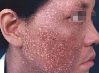 皮肤黑变病 皮肤黑变病 皮肤变黑病是怎么形成的