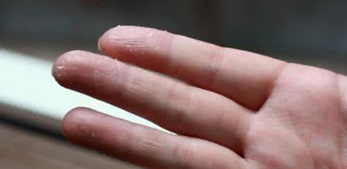 皮肤病传染途径 手指皮肤病有哪些会传染吗