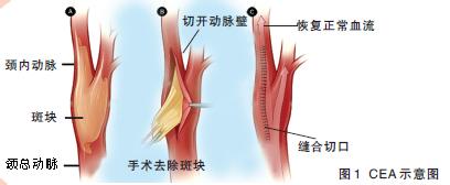 颈动脉狭窄内膜剥脱术 生命之桥颈动脉的狭窄：内膜剥离术还是支架治疗？ ——CCS 2016
