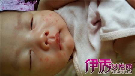 痱子症状图片 看痱子症状图片 了解痱子症状