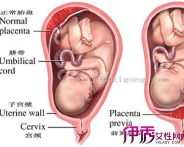 子宫前壁肌瘤是什么 子宫底前壁什么意思？