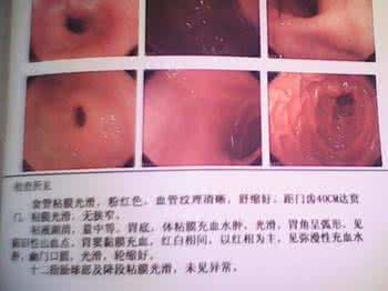 郁方的阳毛图片 5.通阳散郁方治疗慢性浅表性胃炎