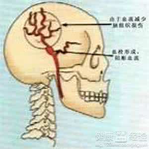 脑供血不足的病因 脑供血不足的治疗 是什么病因引起的