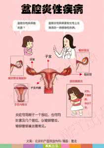 盆腔炎发病是什么情况 盆腔炎发病是什么情况 盆腔炎发病的原因有哪些