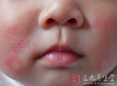 湿疹 药膳 湿疹的原因 3款药膳助力缓解湿疹不适
