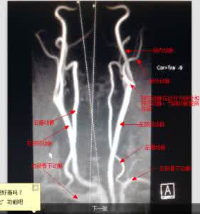 脑血管造影 脑血管造影高清图解 WIFI打开