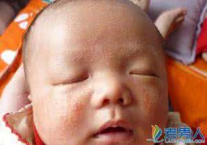 新生儿面部湿疹怎么办 新生儿患了湿疹该怎么办？