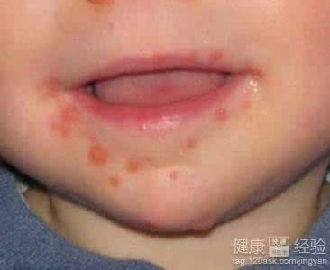 手足口病初期症状 手足口病初期症状 手足口病的初期症状有哪些