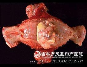 子宫平滑肌肉瘤 子宫肉瘤是什么 子宫肉瘤的诊断方法是什么