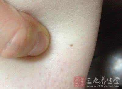 痣多是癌症的前兆吗 痣长在这地方竟等于癌症前兆