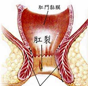 治疗肛裂的有效方法 肛裂的治疗 这些方法有效治疗肛裂