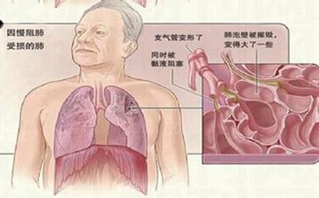 慢性阻塞性肺病治疗 慢性阻塞性肺疾病 如何治疗慢性阻塞性肺病