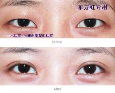 做重睑术 重睑术 什么时候做重睑术效果好？