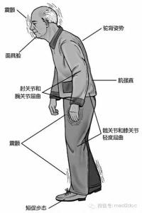 帕金森病特效药 帕金森氏病效方